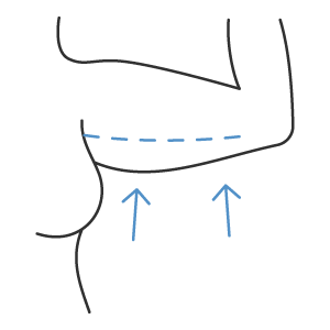 Braquioplastia