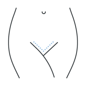 Ninfoplastia ou Labioplastia (cirurgia íntima feminina)