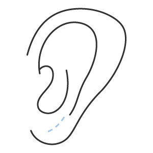 Lobuloplastia (cirurgia da orelha rasgada)