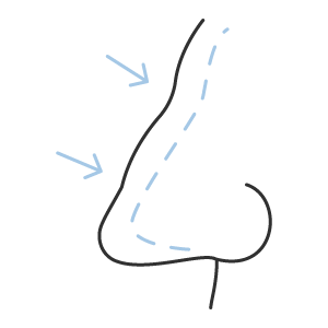 Rinoplastia (correção do contorno nasal)