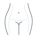 Abdominoplastia