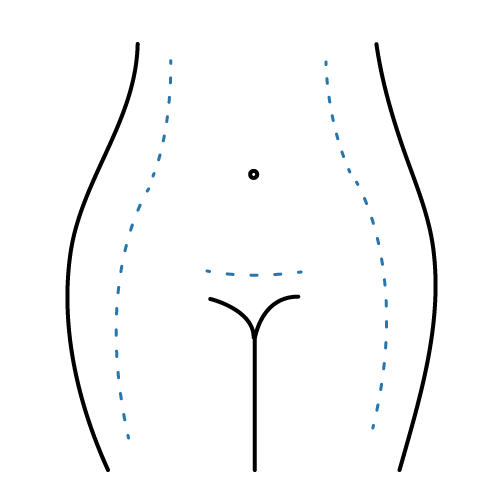 Miniabdominoplastia